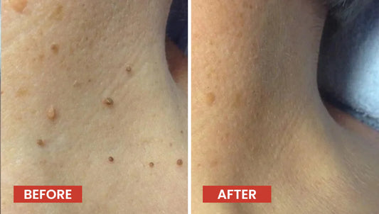 DermaSmooth Skin Tag Remover Patch